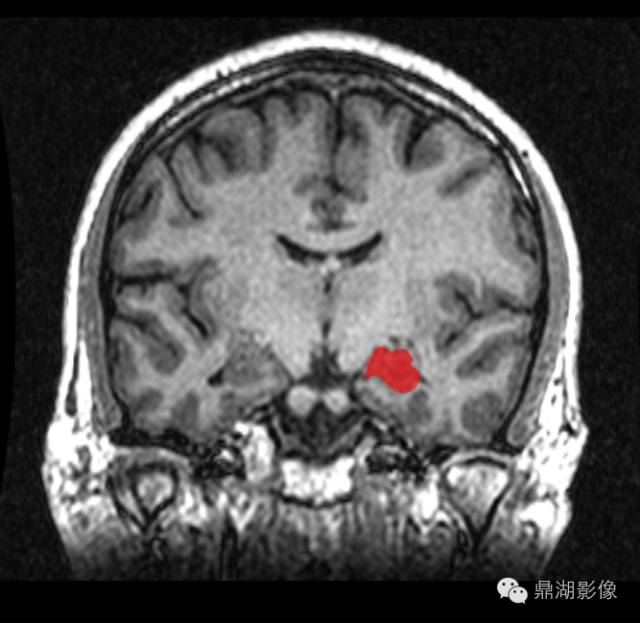 fusiformgyrus图片