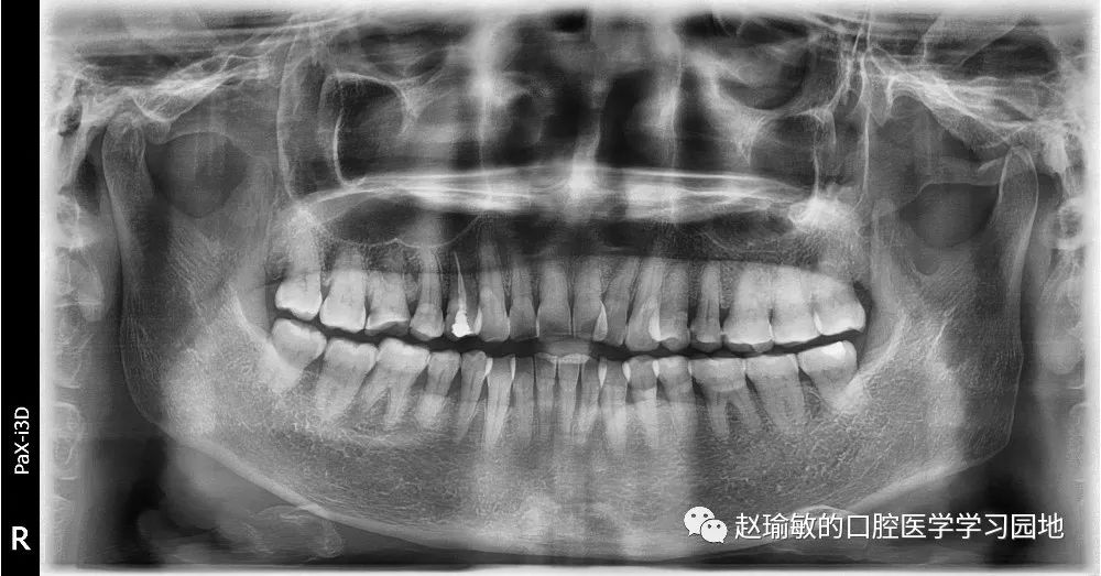 牙根吸收x光片图片