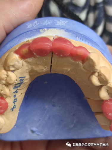 牙体解剖5上颌侧切牙