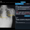 肺结核智能筛查系统