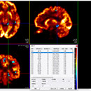 基于人工智能的脑部正电子断层扫描分析系统