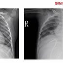 肺部感染识别