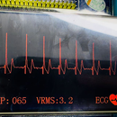 基于STM32的ECG心电监护仪