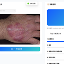 基于 EfficientNet-B3 注意力增强与 CfC 液态神经网络分类头的皮肤病变智能诊断系统